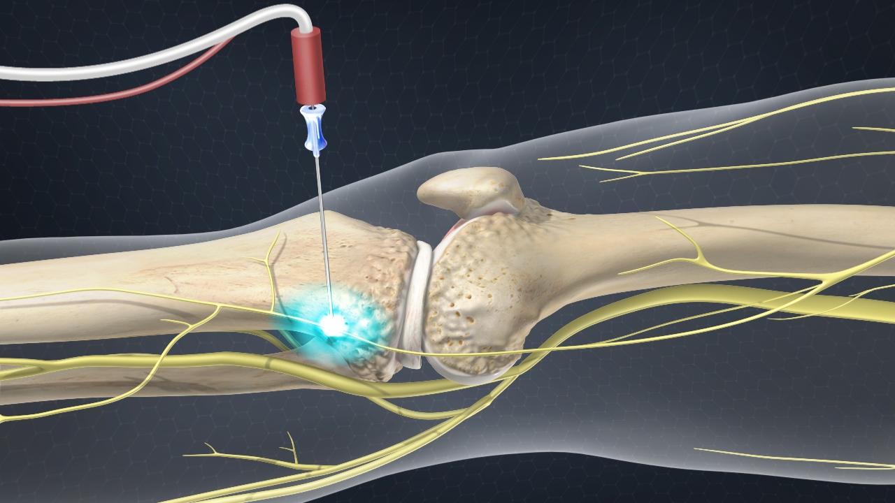 genicular-nerve-ablation-coastal-spine-and-pain